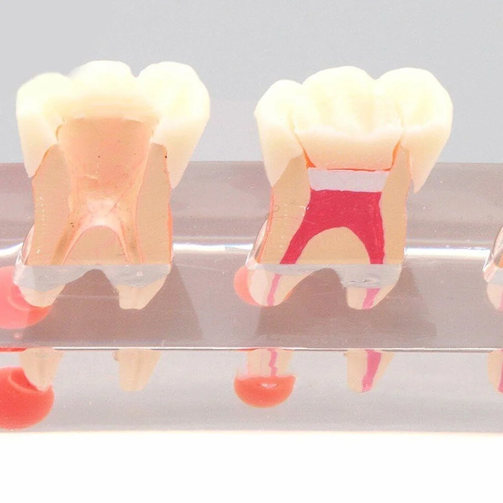 Model zębów dentystycznych leczenie endodontyczne przezroczysty demonstruje model nauczania stomatologicznego model do nauki nauczania edukacji pacjenta