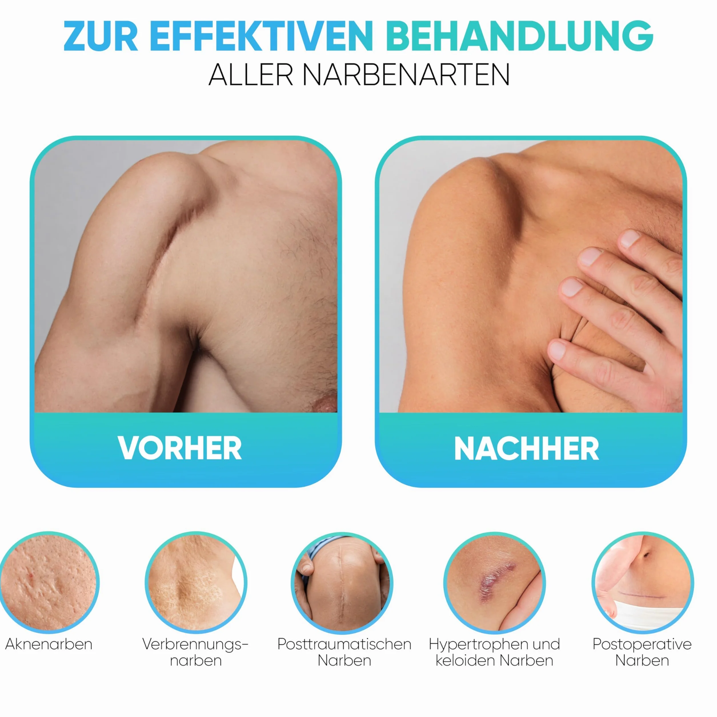 Health Press® Żel na blizny – 20 ml maść na blizny – żel na blizny zmniejsza widoczność blizn – krem na blizny do wszystkich rodzajów blizn – pielęgnacja blizn – krem na blizny dla dorosłych i dzieci