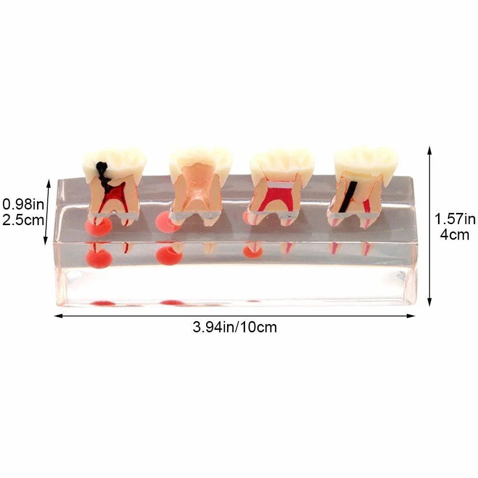 Model zębów dentystycznych leczenie endodontyczne przezroczysty demonstruje model nauczania stomatologicznego model do nauki nauczania edukacji pacjenta