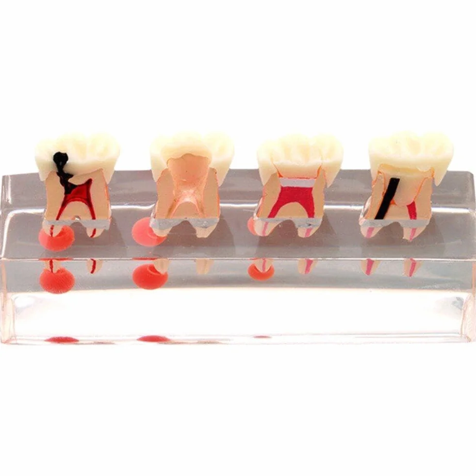 Model zębów dentystycznych leczenie endodontyczne przezroczysty demonstruje model nauczania stomatologicznego model do nauki nauczania edukacji pacjenta
